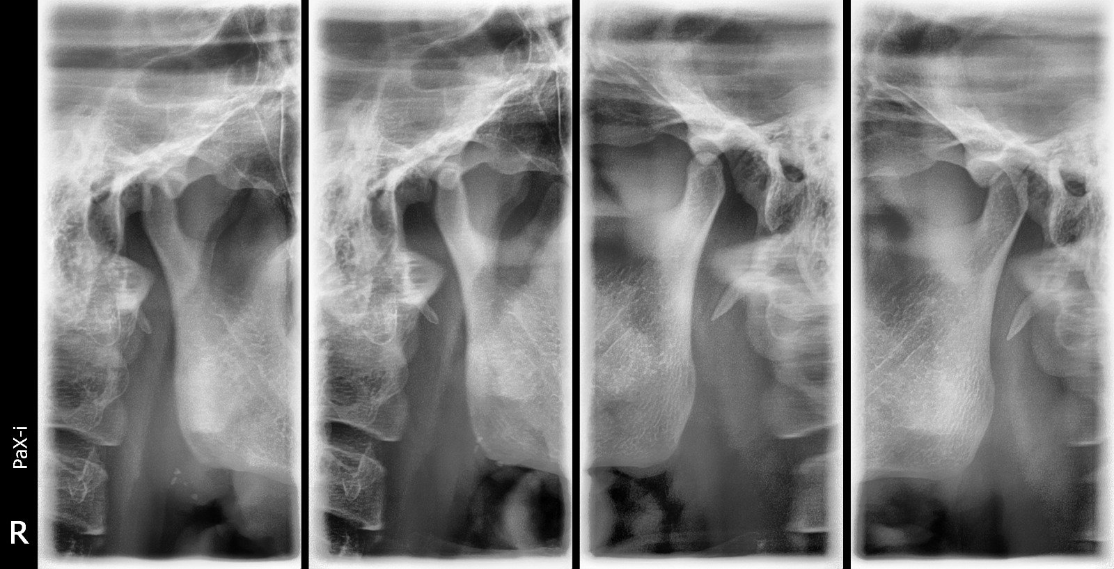 Imagen de Rx ATM Articulación Temporomandibular 