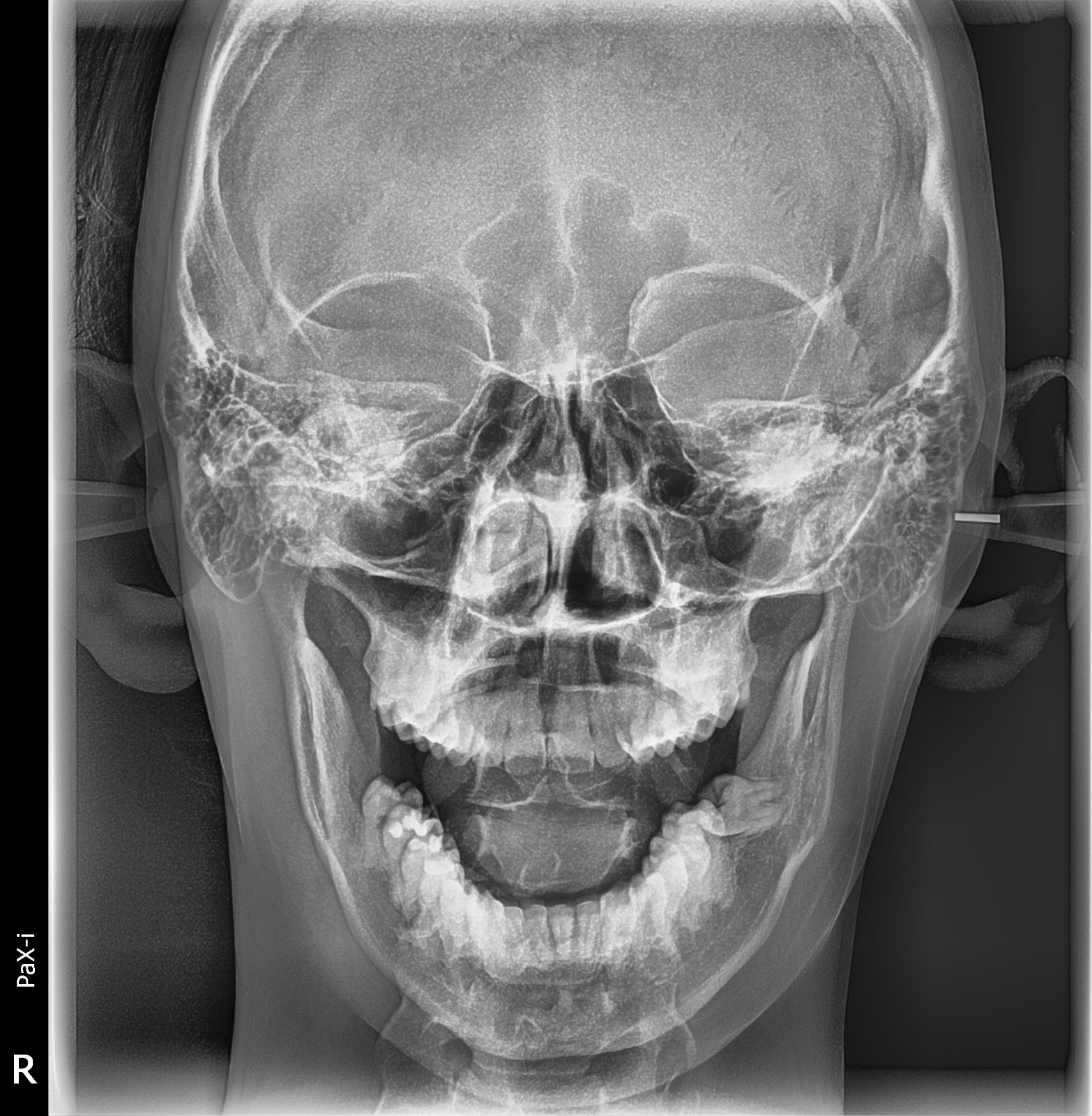 Imagen de Rx Postero-Anterior 